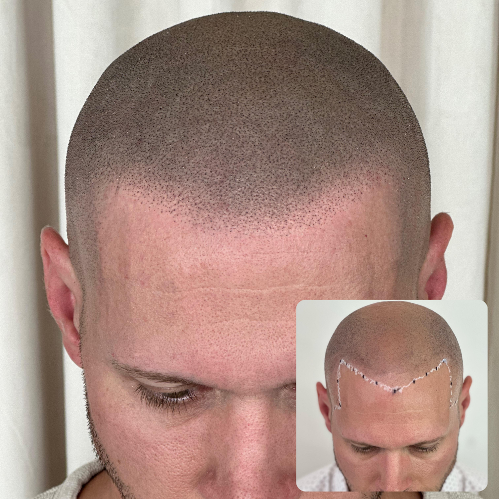 Density Micropigmentation before & after 1000x1000 (19)