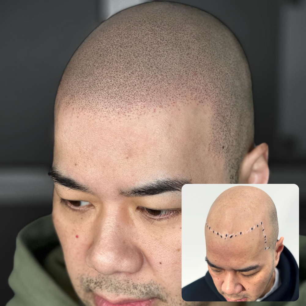Density Micropigmentation before & after 1000x1000 (20)