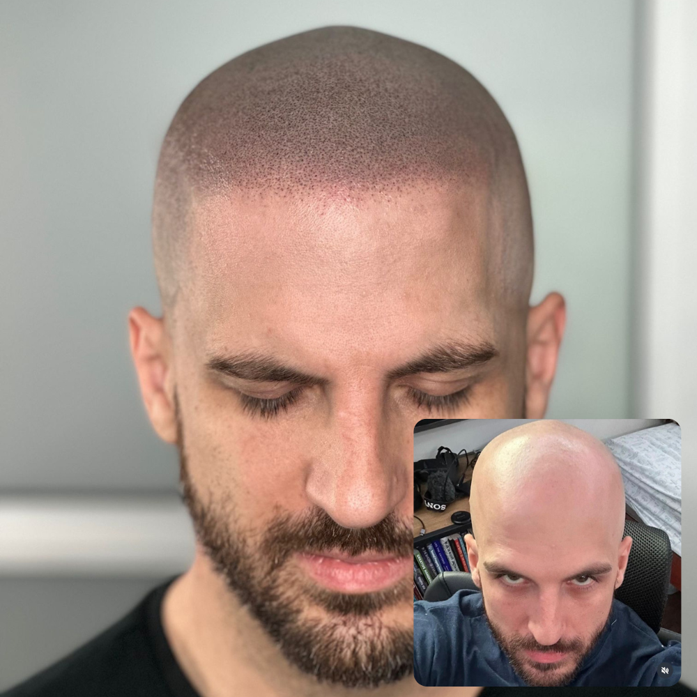 Density Micropigmentation before & after 1000x1000 (22)